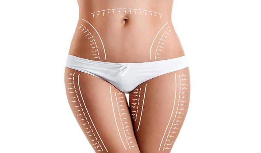 360-Grad-Liposuktion für eine rundum definierte Körperkontur – Fettabsaugung für natürliche Ergebnisse und ästhetische Harmonie.